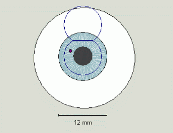 excimer laser impacten